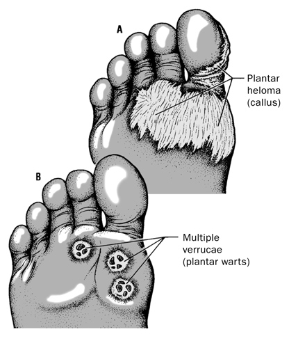 Callus and Warts Medical Illustration