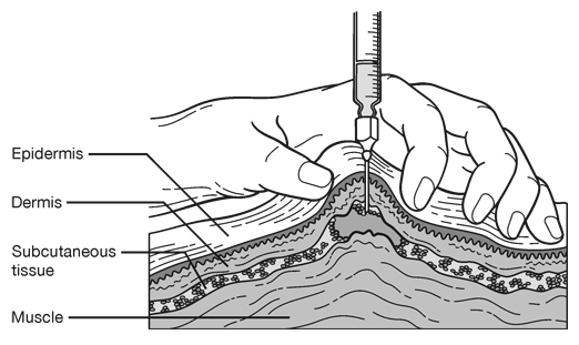 Method of Insulin Injection Medical Illustration