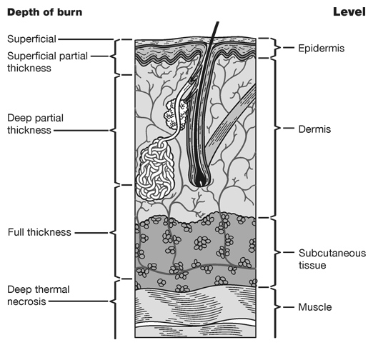 Skin Burns by Depth Medical Illustration